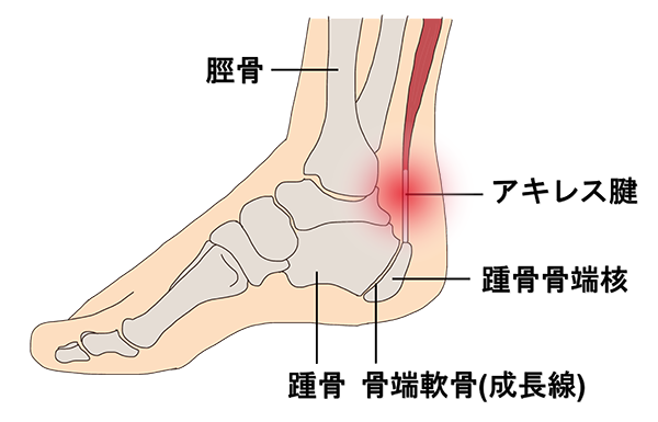アキレス腱炎（アキレス腱周囲炎）とは？