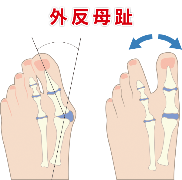 外反母趾とは？