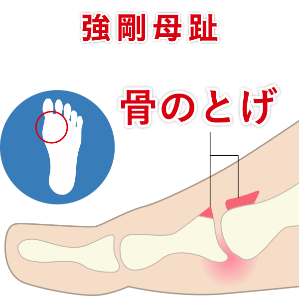 強剛母趾