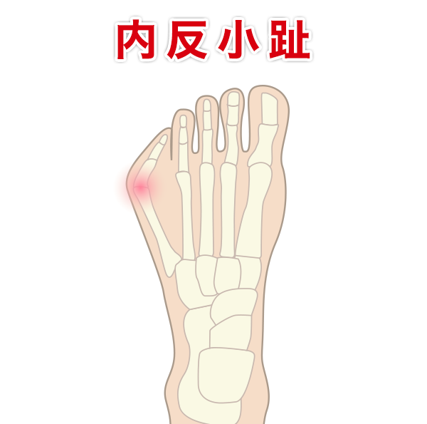 内反小趾