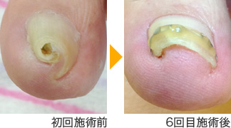 ワイヤーを外し卒業