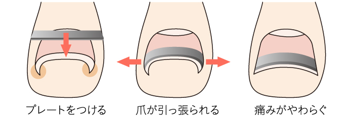 プレートでの矯正