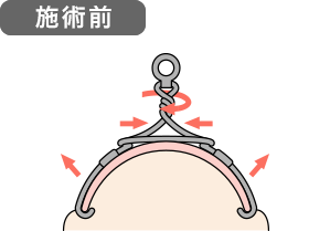 当店のワイヤー矯正 施術前