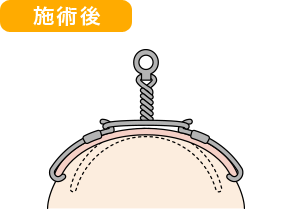 当店のワイヤー矯正 施術後