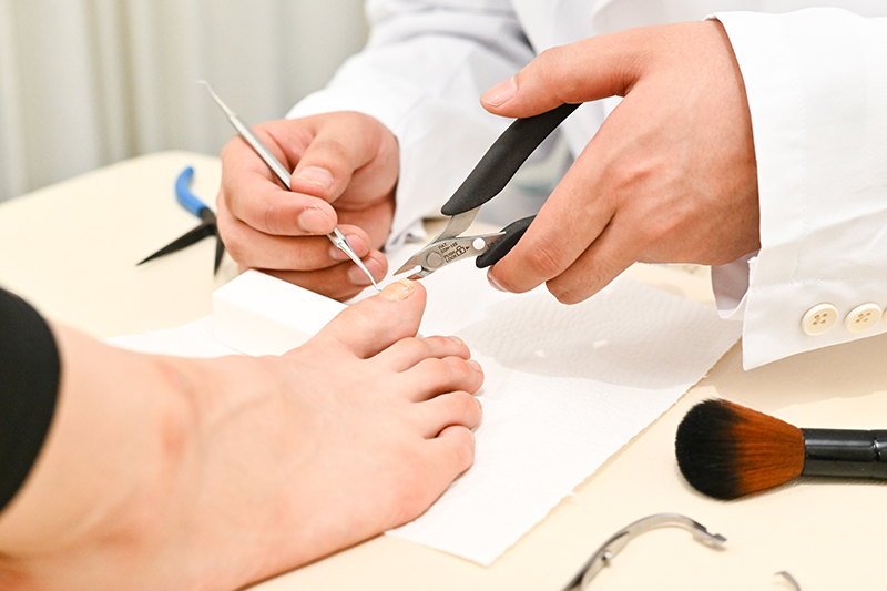 巻き爪矯正コース