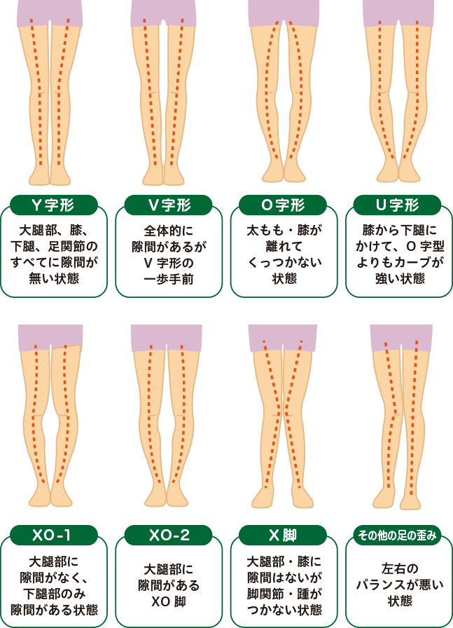 O脚矯正対応症状