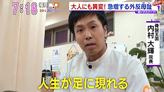 KBCアサデス　大人にも異変急増する外反母趾