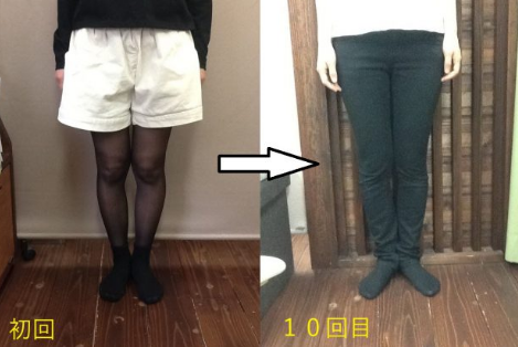 たった１０回で膝下がついた！１０代女性の喜びの声