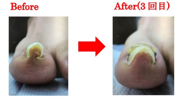 酷い巻き爪で人にも見られたくなかったのですが今では見せびらかしています！