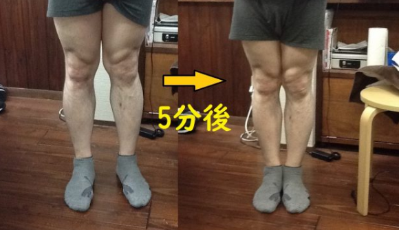 治療側も驚いた！Ｘ脚が短時間で変化