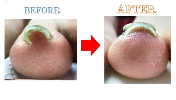 長年の巻き爪も解消しました！今は痛みもありません！