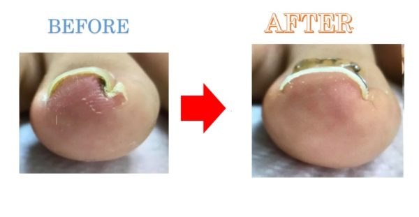 酷いときは腫れあがり歩くのも辛かったが、痛みなく帰れました！