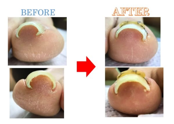両足の巻き爪、きっちり戻りました！