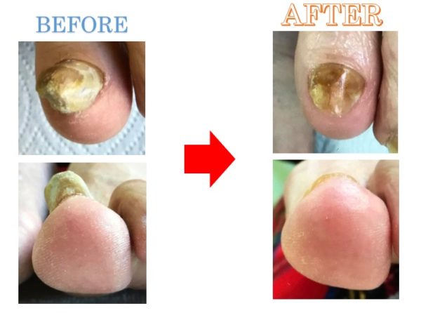 肥厚爪の原因とは？