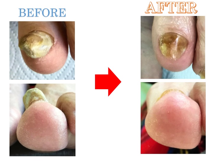 肥厚爪の原因とは？