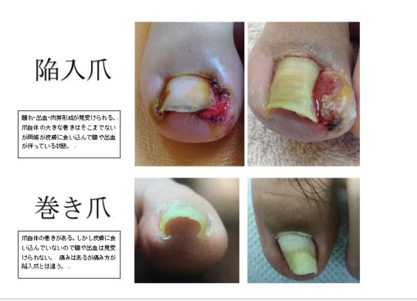 陥入爪になる原因