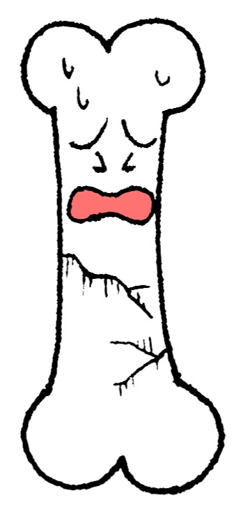 疲労骨折は甘く見ていると後遺症にまで発展してしまいます。