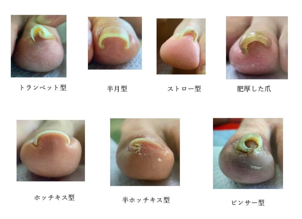 弯曲爪（巻き爪）の種類と原因