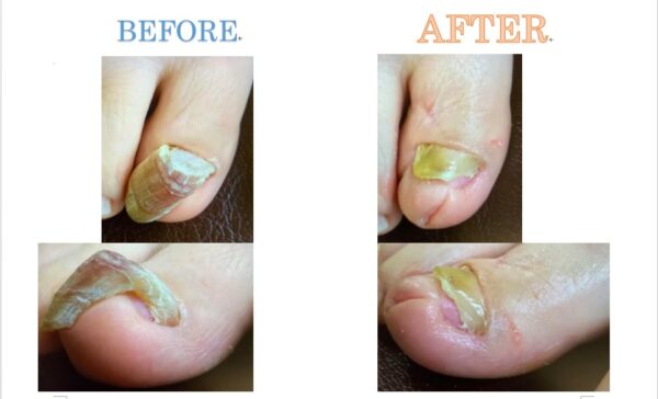 爪甲鉤彎症かもしれないと思ったあなた！改善できますのでご安心ください