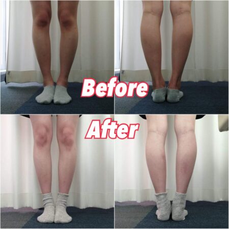O脚の施術でコンプレックスが解消されました！