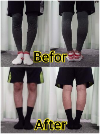 O脚で来院しました！