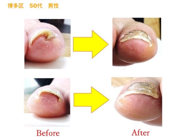 安全靴が痛く、仕事に支障が出ていました