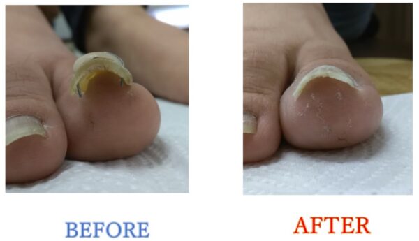 厚くて、巻きの強いどうしようもない爪が生まれ変わりました！感動