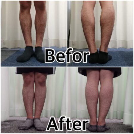 O脚で来院しました