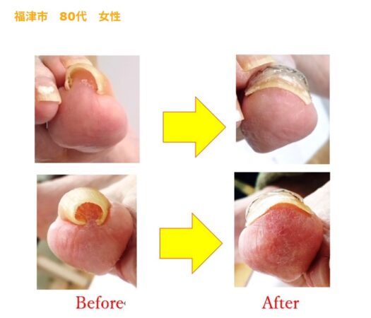 強い巻きで、皮膚の盛り上がりが矯正で、昔のいい爪に戻りました！