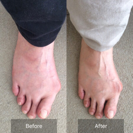 10年前から外反母趾がありました