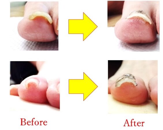 もう治らないと思われていた、母趾と薬指の巻き爪を改善しました♪