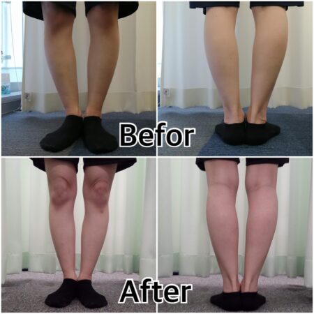 長年O脚で悩んでいた