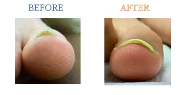 巻き爪矯正中でもサッカーの練習ができたのですごく助かった！