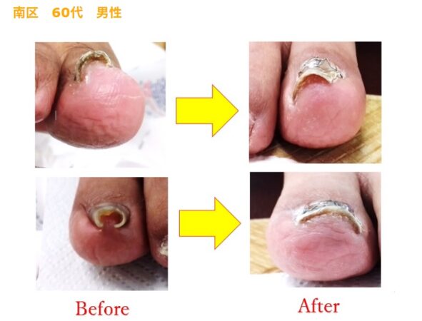 ずっと辛かった爪が回数を重ねるごとに良い状態なってきました