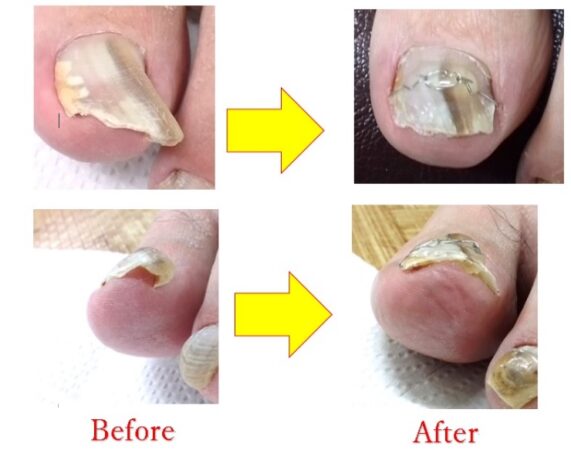 強く湾曲して分厚くなってしまった爪が良くなりました