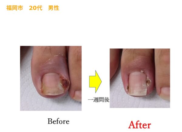 腫れがずっと引かなかった状態でしたがすぐに引きました！