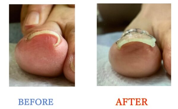 食い込みが強く毎回爪切りが怖かったけど、今はその心配もありません。