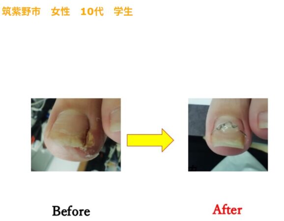 小学生の巻き爪。体育の授業中の痛みも気にならなくなりました！