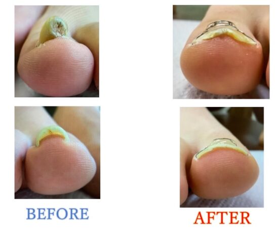 過去に1年かけて矯正したのに再発、ここでは短期間で結果が出て部活も再開できました！