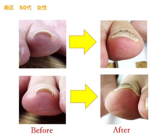 靴を履いた時の痛みから解放されました