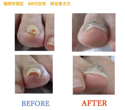 手術は痛いと聞いたので福岡巻き爪センターにお願いしてよかったです！