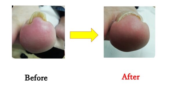 靴を履いても痛くなくなりました！