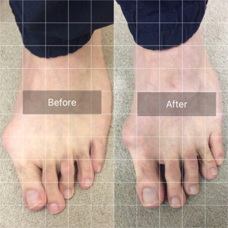 10年前から外反母趾があり・・・