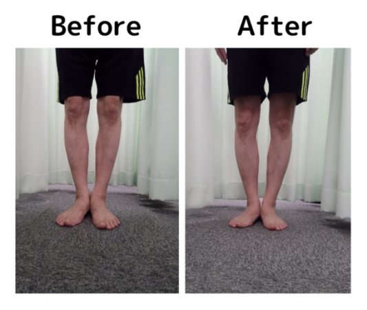 O脚で来院して体の使い方など改めて意識する事が出来ました