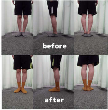 O脚施術で来院しました