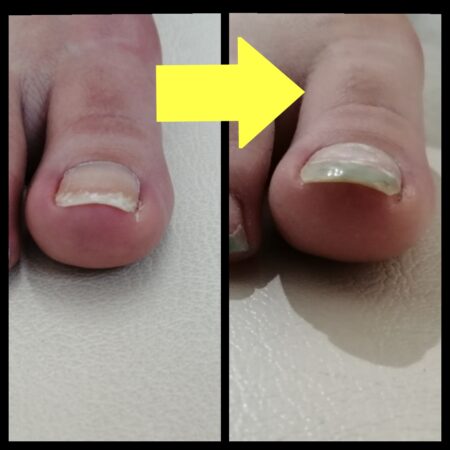 仕事柄ヒールを履くので巻き爪が痛んでいました