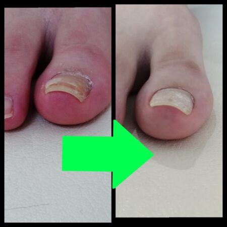 巻き爪で来院して毎回丁寧に施術してくれます