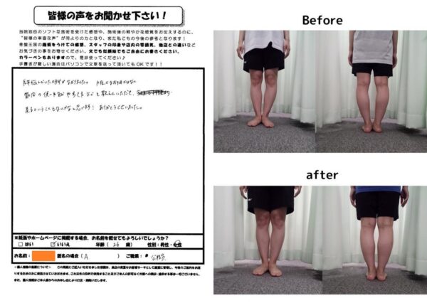 長年悩んだO脚で来院しました