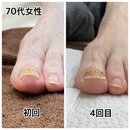70代女性初回施術と4回目