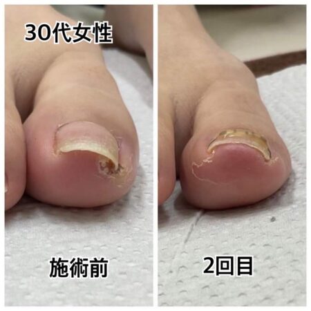 30代女性初回施術2回目